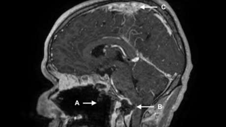 Un adicto muere poco después de ingresar a urgencias con el paladar destruido por consumir cocaína