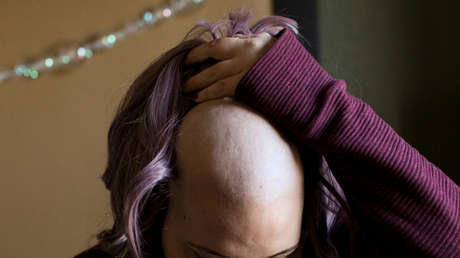 Una nueva estrategia médica podría evitar la caída del cabello durante la quimioterapia
