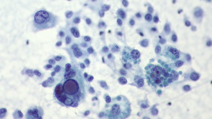 Pierde gran parte del cuello por culpa de un lunar y ahora conciencia al mundo sobre el riesgo del melanoma