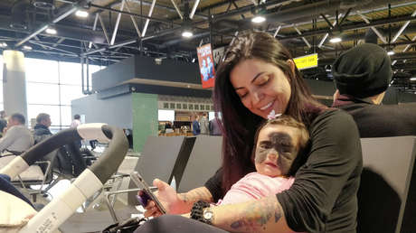 Médicos rusos operan a una bebé de EE.UU. para quitarle una mancha oscura que le cubre casi todo el rostro