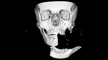 FOTOS: Reconstruyen el rostro de una adolescente con una mandíbula partida en dos tras un accidente durante un paseo a caballo