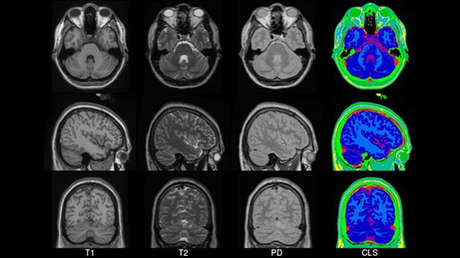 Un estudio revela que los indios tienen el cerebro más pequeño que sus vecinos asiáticos y que los europeos