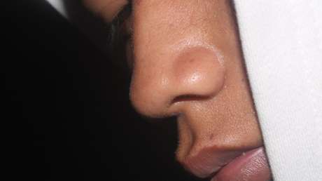 Extraen un paquete de marihuana que permaneció 18 años en la nariz de un hombre