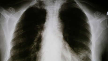 Google enseña a la IA a diagnosticar condiciones pulmonares con la precisión de un especialista humano