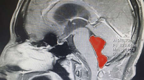 Sufre dolores de cabeza, un desmayo y descubre que tenía desde hace años un gusano en su cerebro