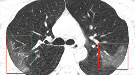 Muestran el impacto del nuevo coronavirus en los pulmones de una paciente