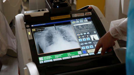 Hallan con una tomografía signos de coronavirus en los pulmones de una joven sana y sin síntomas