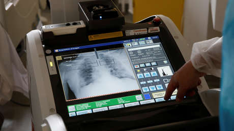 Realizan el primer trasplante de pulmón de Europa en un paciente con covid-19