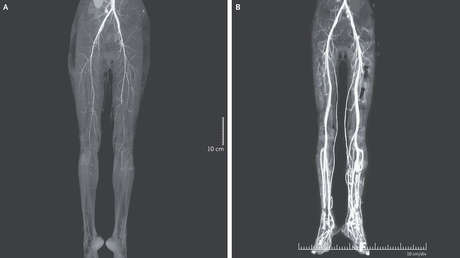 Una joven de 24 años consume un medicamento para la migraña y resulta con 'fuego del infierno', una rara enfermedad que era popular en el medievo