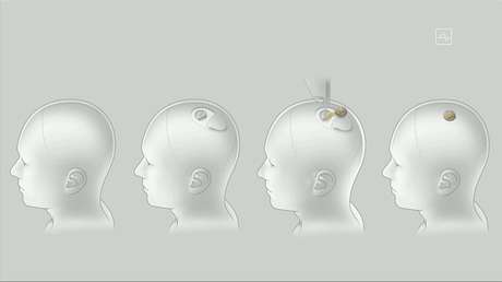 Las redes se inundan de bromas tras la presentación del chip de Neuralink de Elon Musk que se conecta al cerebro