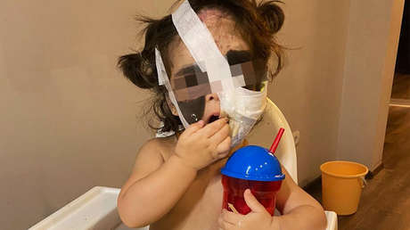 Operan por tercera vez en Rusia a la niña nacida con 'máscara de Batman'