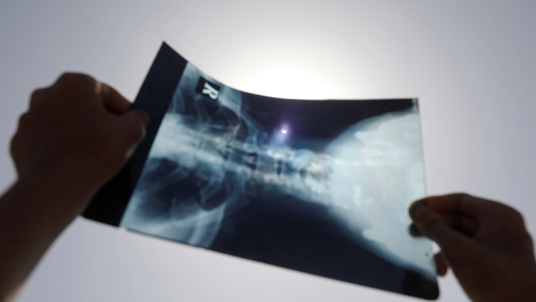 Tres pacientes tratados con tocilizumab contra el covid-19 desarrollaron daños en la médula espinal