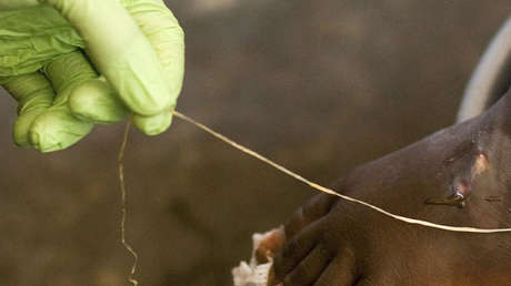 Una enfermedad parasitaria manifestada por un gusano que sale del cuerpo humano a través de una ampolla, al borde de la erradicación