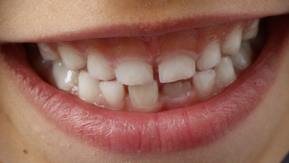 VIDEO: Un doctor extrae un diente atorado en el tímpano de un niño de 3 años