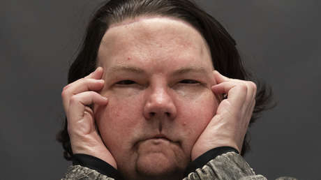 Realizan con éxito en EE.UU. el primer trasplante simultáneo de cara y manos