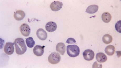 Advierten sobre el auge de la babesiosis en EE.UU., una peligrosa infección transmitida por garrapatas que ataca a los glóbulos rojos