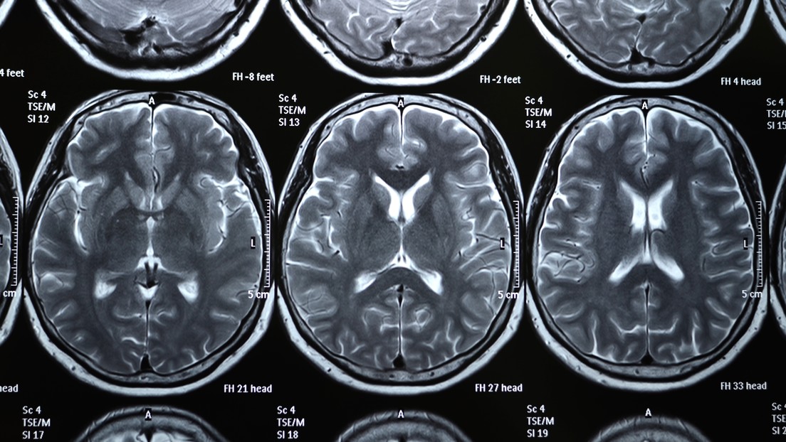 Un nuevo estudio concluye que incluso los casos leves de covid-19 podrían conllevar pérdida de materia gris