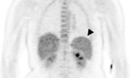 Inyección de malaria aplicada a voluntarios sanos permite entender dónde se esconde después de la infección