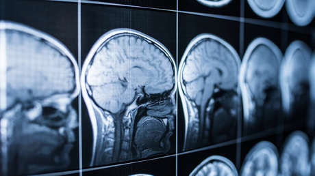 Un hombre afirma que perdió la capacidad de sentir miedo luego de que le extirparan parte del cerebro