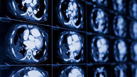 "Me aplastan los pulmones": Un hombre con los riñones gigantes será operado para evitar una muerte segura