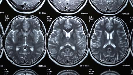 Un nuevo estudio concluye que incluso los casos leves de covid-19 podrían conllevar pérdida de materia gris
