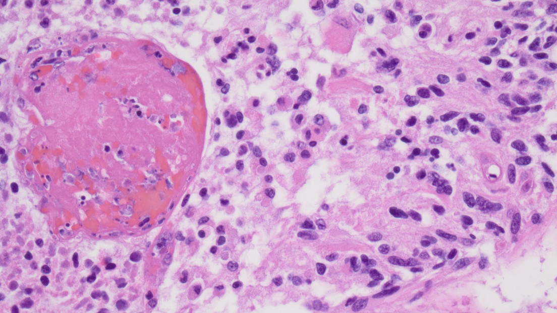 Científicos imprimen en 3D el primer tumor cerebral maligno activo del mundo (VIDEO)