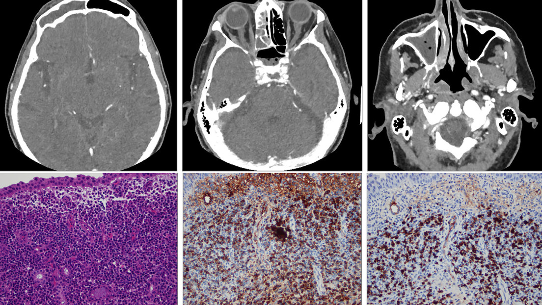 Un hombre pierde la visión en un ojo debido a una bacteria tras contraer el covid-19