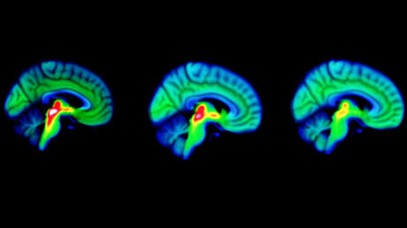Descubren que la proteína llamada en honor a Sonic el Erizo podría ayudar en el tratamiento del párkinson