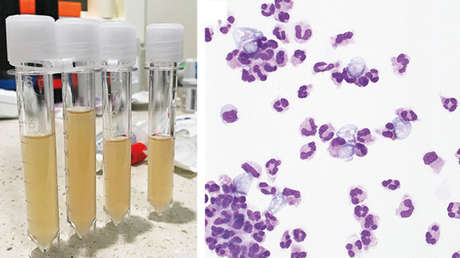 Muere un niño tras infectarse con una ameba 'comecerebros' al visitar un parque acuático de Texas