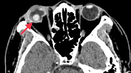 Le cae a la cabeza un durián y le provoca lesiones tan graves en un ojo que tienen que operarlo
