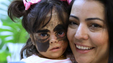 Una niña de EE.UU. se recupera tras una cirugía pionera en Rusia que eliminó una enorme marca de nacimiento de su rostro