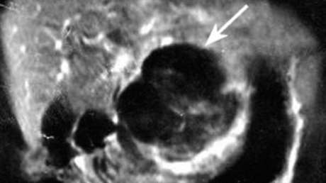 "Es la primera vez que lo veo": un médico cuenta cómo fue sorprendido por el caso de una mujer con un feto en el hígado