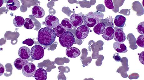 Miles de pacientes con linfoma podrían recibir un fármaco 'caballo de Troya' que destruye las células tumorales