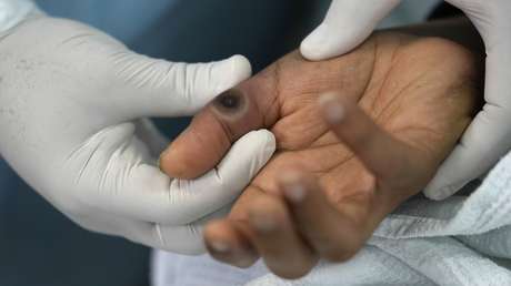 Tres países sudamericanos se ubican entre los diez con más casos de viruela del mono