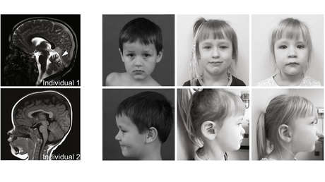 Descubren una nueva rara enfermedad neurológica