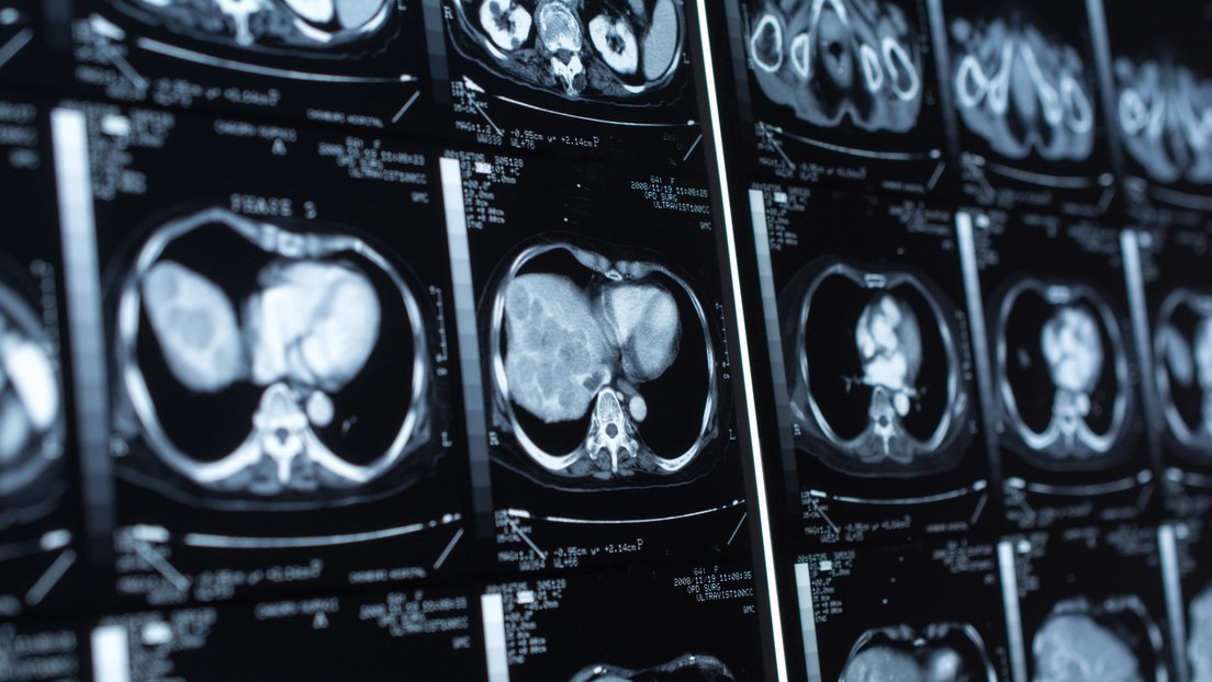 Crean en Irán una prueba para detectar infartos con solo una gota de sangre del dedo