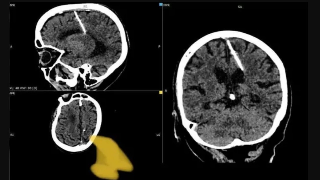 Una anciana rusa vivió 80 años con una aguja en el cerebro