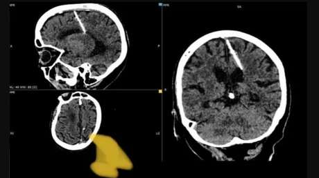 Una anciana rusa vivió 80 años con una aguja en el cerebro