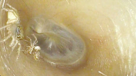 Un médico descubre la 'aterradora' razón por la que una mujer oía ruidos en su oreja