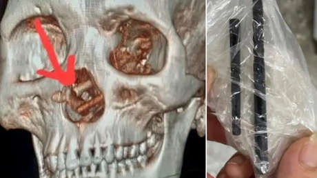 Acude a un médico y descubre que ha vivido con palillos en su cráneo durante 5 meses sin saberlo