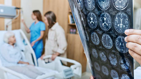 Descubren que un tratamiento médico obsoleto pudo causar transmisión de alzhéimer