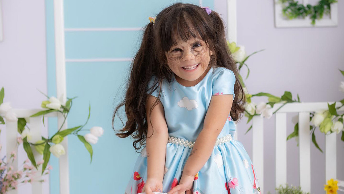 Médicos rusos tratan con éxito a la niña de EE.UU. que nació con 'máscara de Batman'