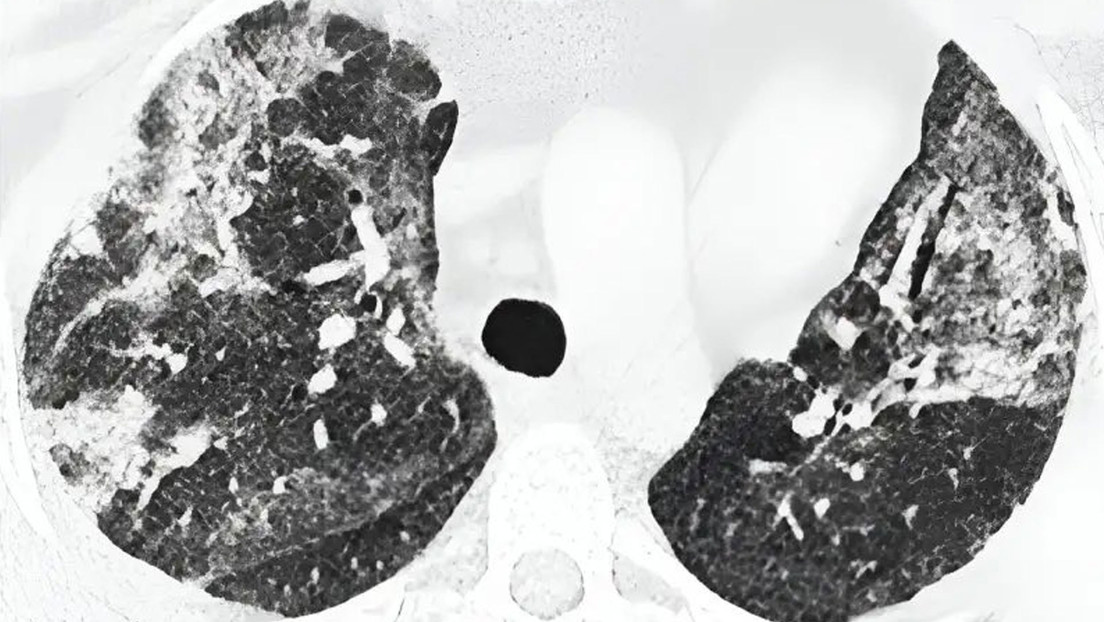 Descubren una rara enfermedad potencialmente mortal relacionada con el covid-19: ¿qué se sabe?