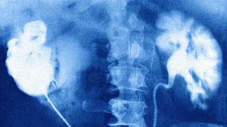 Hallan un factor de riesgo "misterioso" detrás de un tipo de cáncer