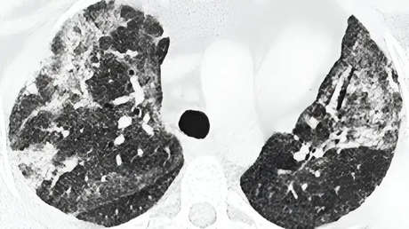 Descubren una rara enfermedad potencialmente mortal relacionada con el covid-19: ¿qué se sabe?