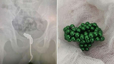 Un adolescente  introduce en su pene 50 bolas magnéticas