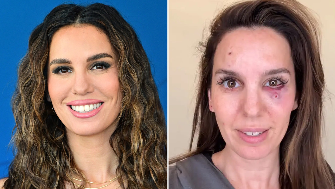 Una exestrella de Disney recibe cinco balines en la cara y sobrevive