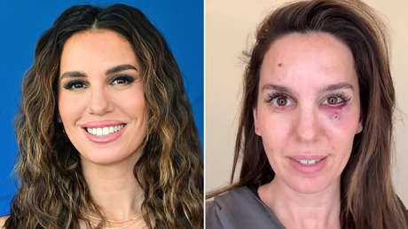 Una exestrella de Disney recibe cinco balines en la cara y sobrevive