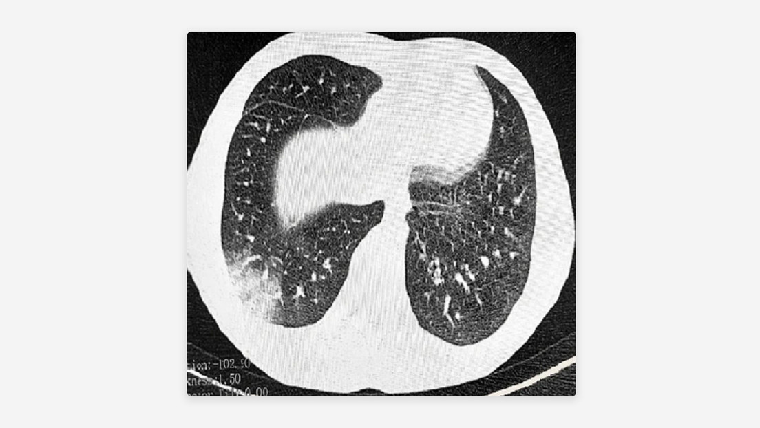 Pulmón de palomitas de maíz: la enfermedad provocada por este hábito