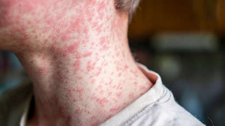 "El sarampión ha regresado": Europa registra la cifra más alta de casos en más de 25 años